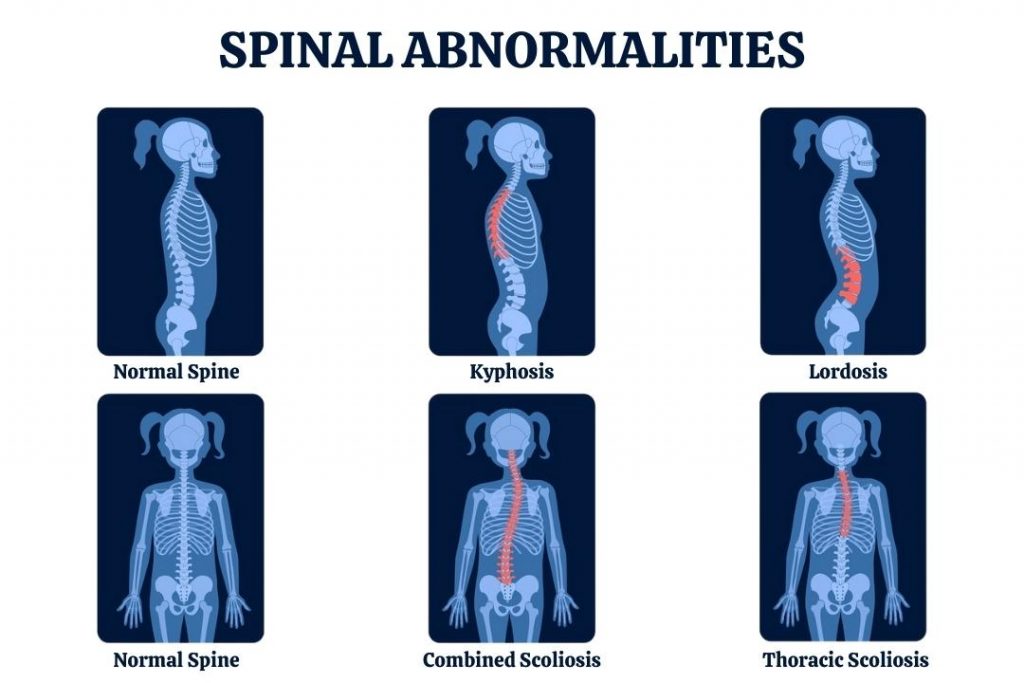 Picture-depicting-spinal-deformities-to-understand-the-basics-for-lumbar-lordosis-straightening