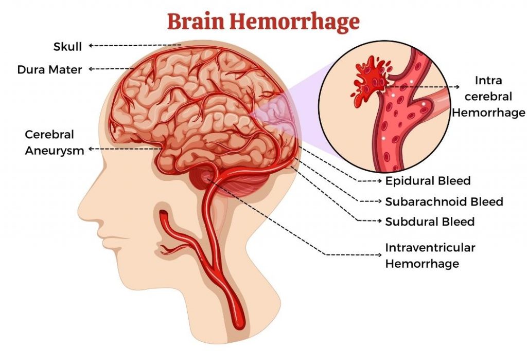 Subarachnoid Hemorrhage - What You Need to Know