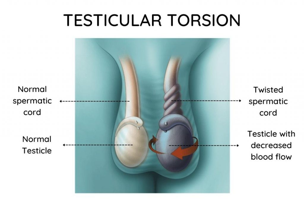 Picture-showing-testicular-torsion