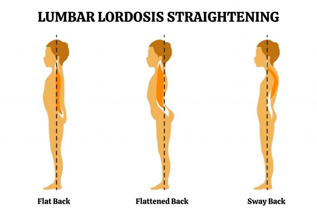 lumbar-lordosis-straightening