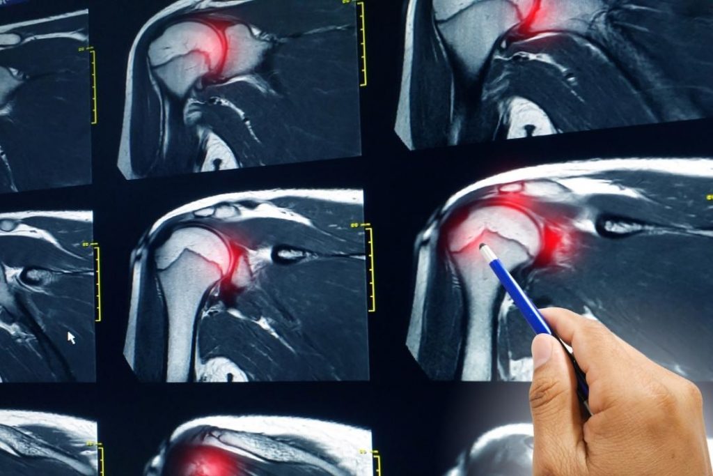 The-MRI-images-of-labral-tear-in-shoulder