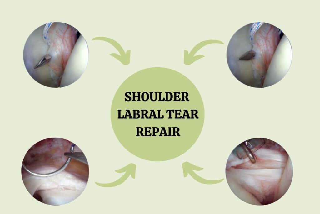 arthroscopic-images-of-the -repair-in-labral-tear-in-shoulder